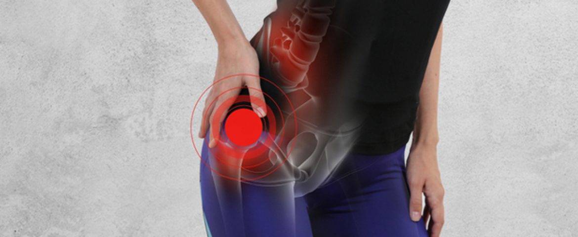 Bursite no quadril: aprenda a evitar e tratar o problema